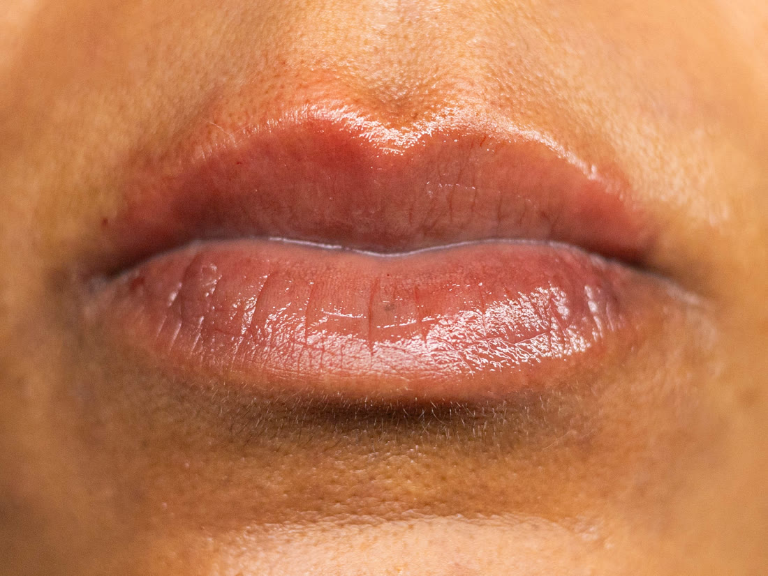 After lip enhancement