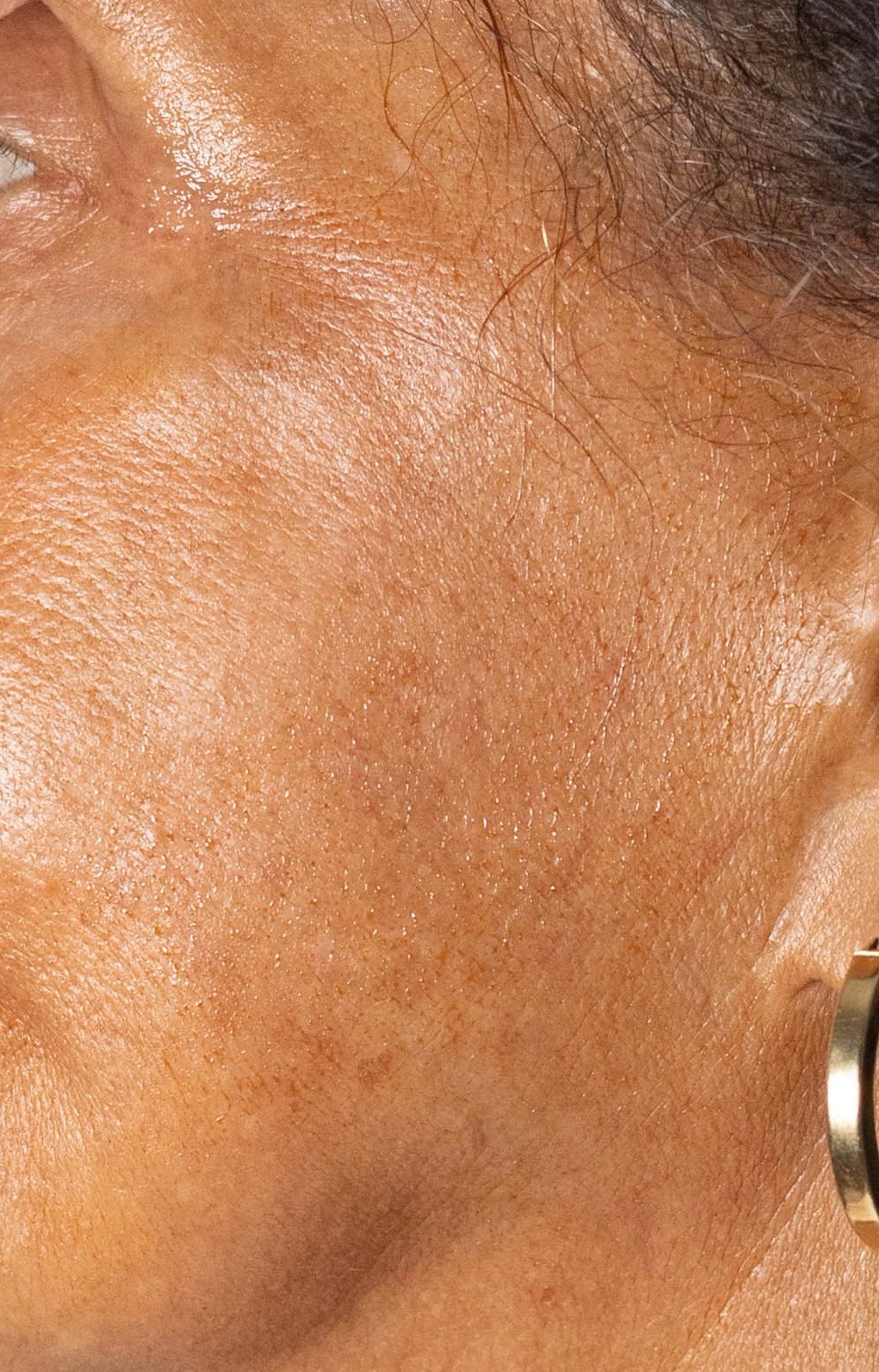 Before chemical peel