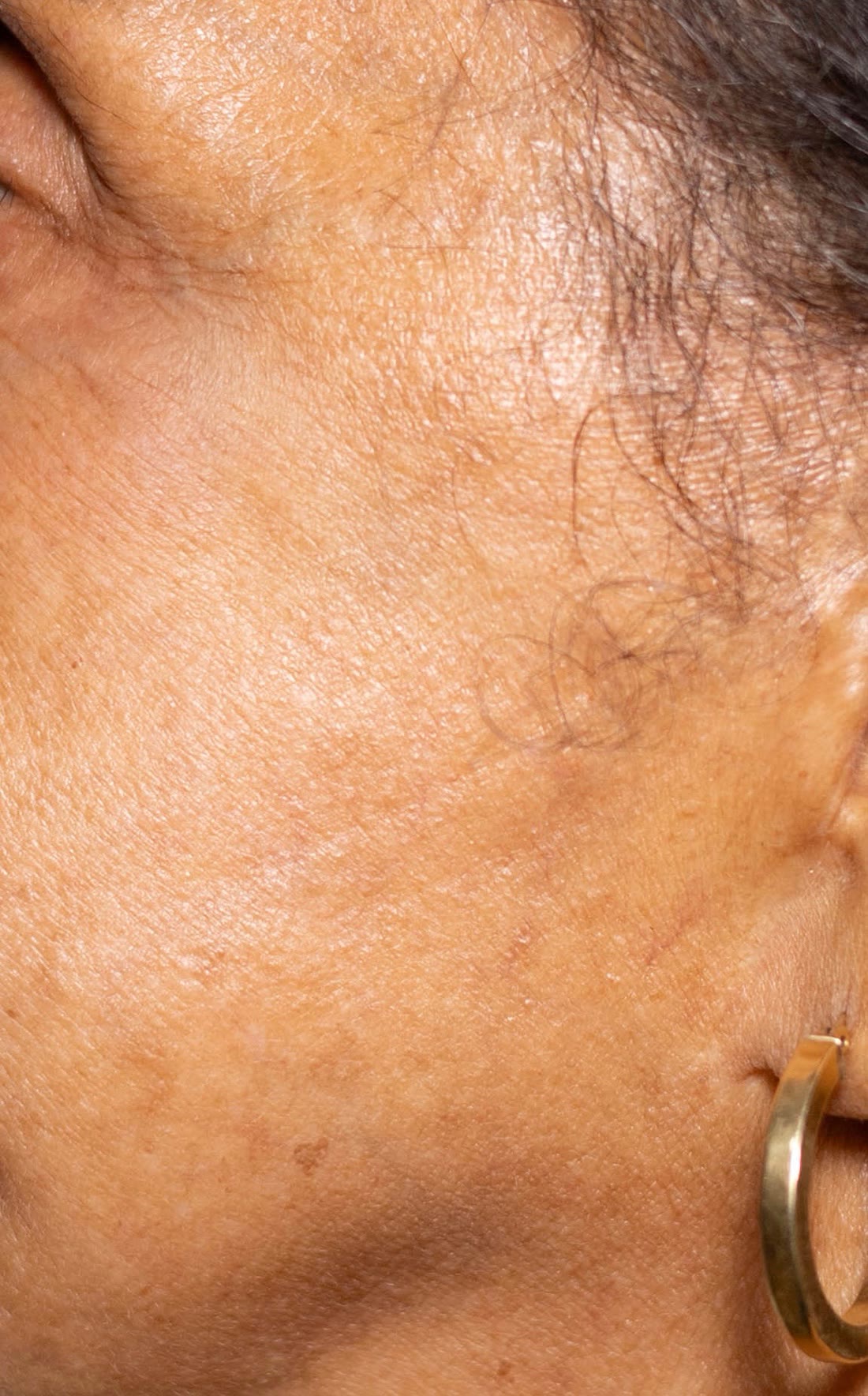 After chemical peel