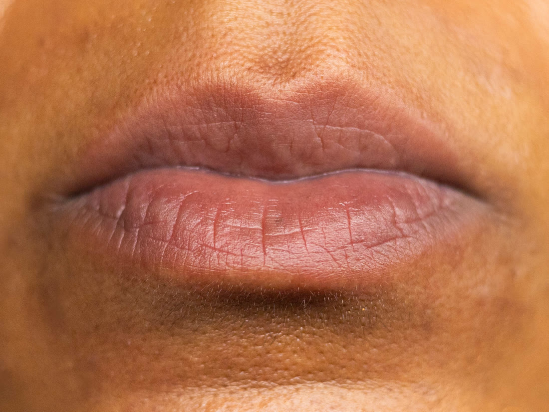 Before lip enhancement